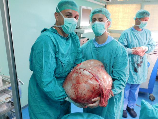 Banjalučki doktori odstranili tumor težak 31 kilogram - Foto: RTRS