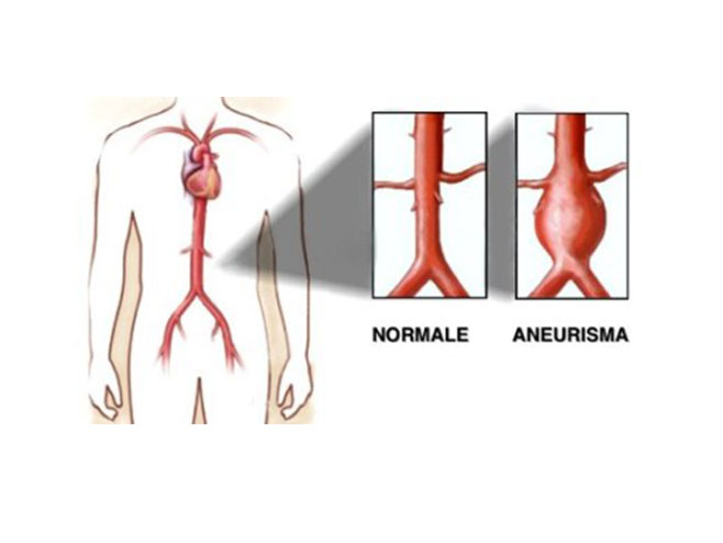 Trbušna aorta (foto:lekarinfo.com) - 