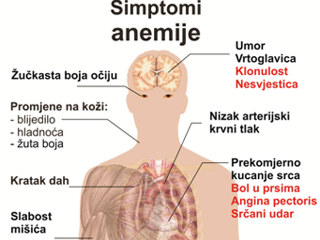 anemija i nizak tlak)
