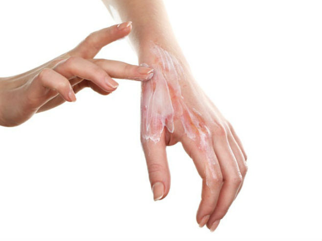 Opekotine na ruci (Foto: Shutterstock) - 