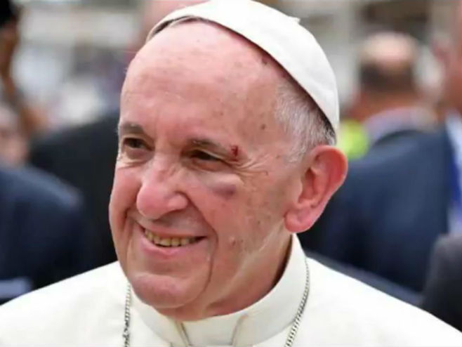 Papa Franjo zaradio modricu na oku - Foto: Screenshot